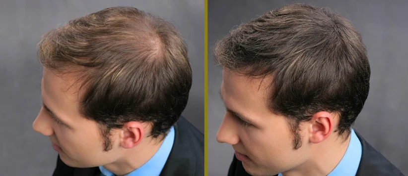 tapar alopecia fibras capilares